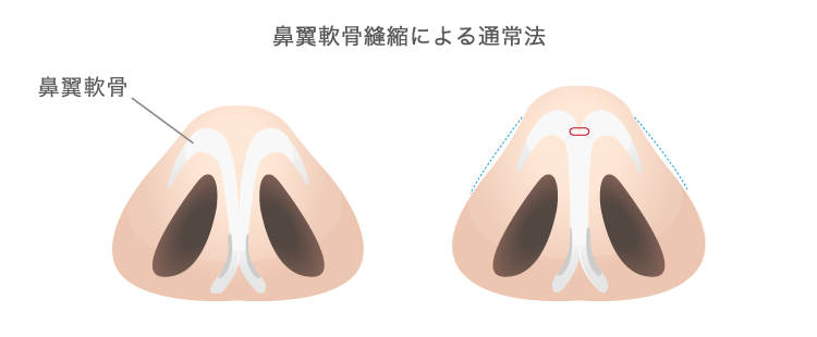 鼻翼軟骨縫縮による通常法